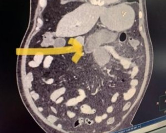 Black fungus of intestine: Novel complication diagnosed in Covid patients in Delhi